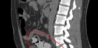 Genova, ragazzino di 16 anni ingoia ovuli di droga per evitare l’arresto