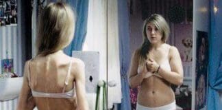 Disturbi alimentari, in Liguria 1500 pazienti, colpiti soprattutto adolescenti Anoressia