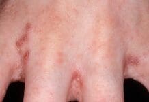 Genova, scabbia in una RSA per anziani Scabbia