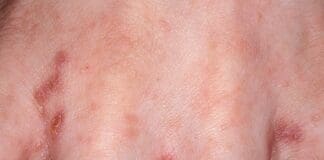 Genova, scabbia in una RSA per anziani Scabbia